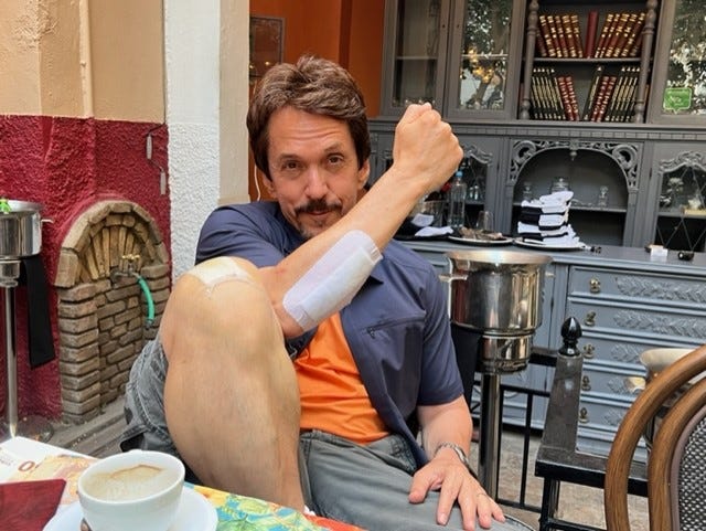 Mitch Albom montre son pansement après l'avoir renversé de son vélo pendant ses vacances à Annecy, en France.