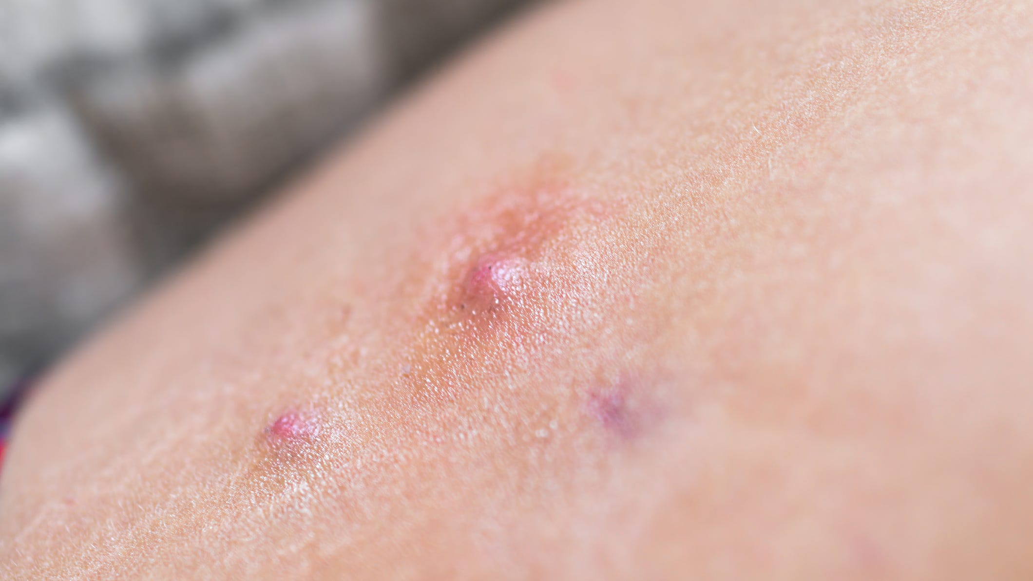 Red bumps may be inflammatory Hidradenitis suppurative