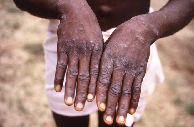 This handout photo, provided by the Centers for Disease Control and Prevention, was taken during an investigation into the 1997 monkeypox epidemic in the Democratic Republic of Congo (DRC) and depicts the dorsal surfaces of monkeypox.  a patient with a characteristic rash in the recuperative stage.