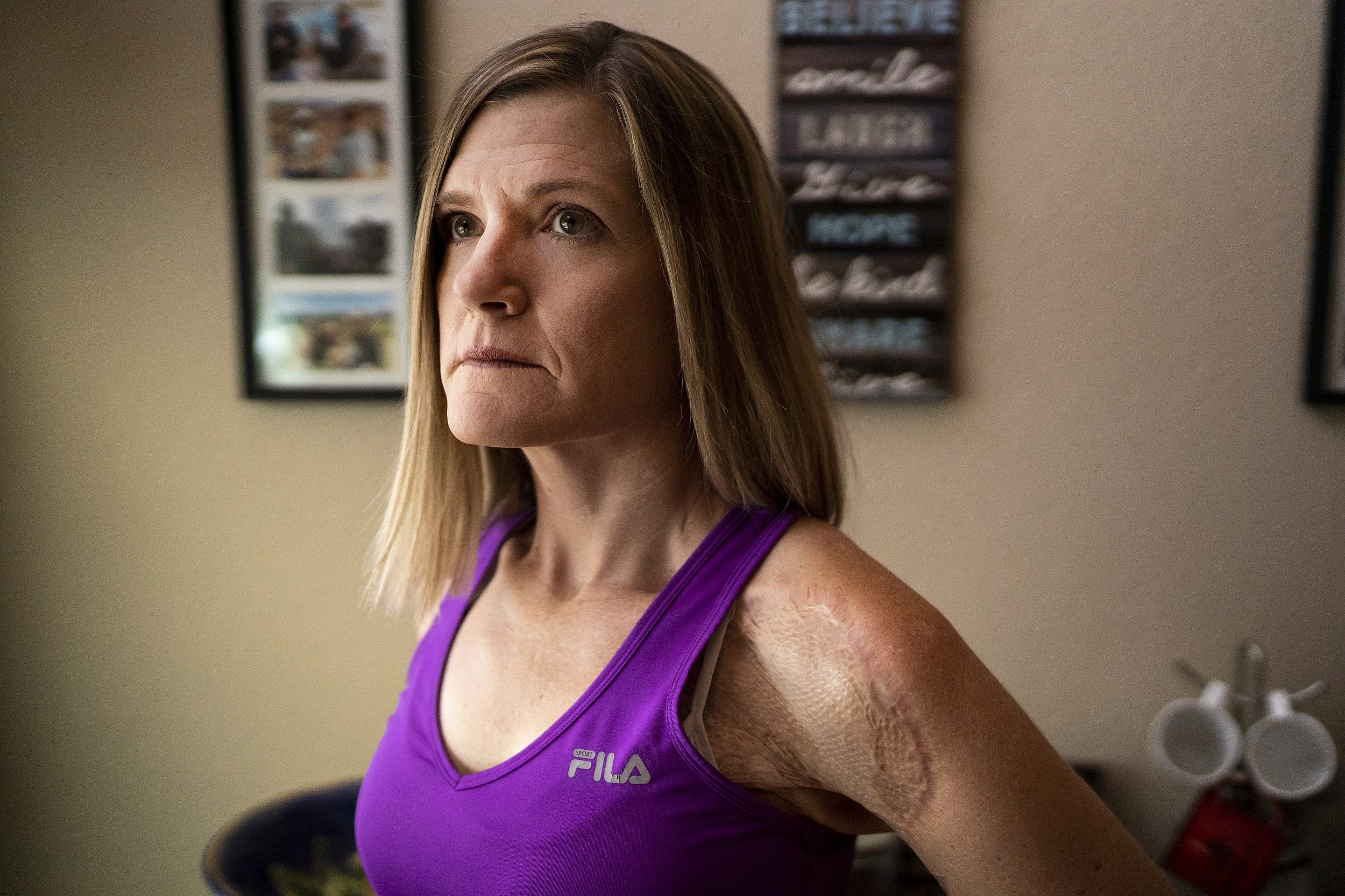 Christin Lipinski at her home on July 21, 2022, in Peoria. Lipinski contracted necrotizing fasciitis, a rare bacterial infection, in January of 2018 and spent 2.5 months in the Arizona Burn Center at Valleywise Health Medical Center.