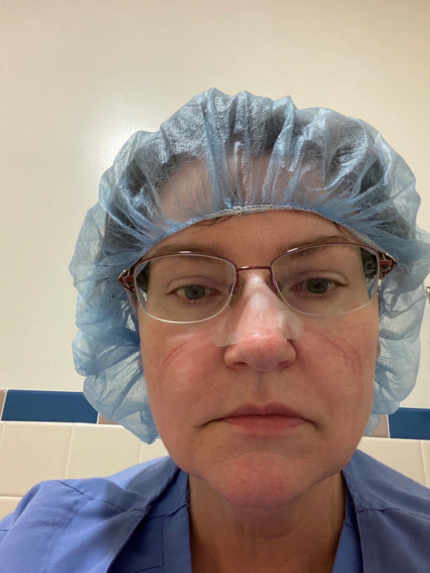 Margaret Franks, a nurse at Vassar Brothers Medical Center, took this picture of herself. It shows the red lines and rough skin on her face caused by wearing an N-95 mask for extended periods during the COVID-19 pandemic, she said