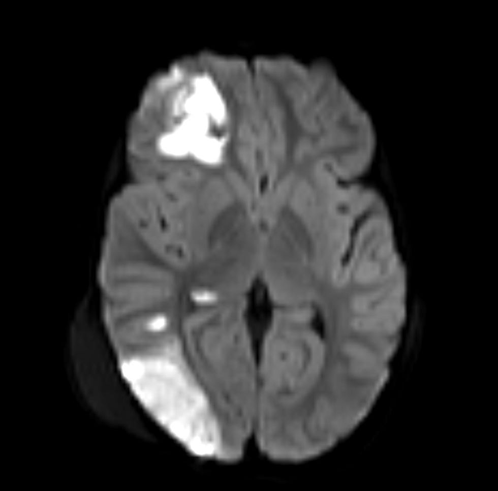 An MRI image of Charlie’s brain shows areas of stroke on the right side as a result of the lack of blood flow to the brain.