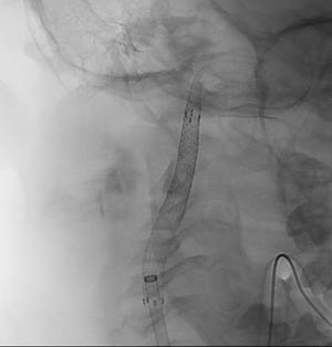 An X-ray shows the stents placed to reconstruct the portion of Charlie’s carotid artery, which had been damaged by the metal straw.