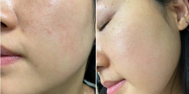 Before the skin cycle, I often dealt with patches of redness, as well as occasional breakouts and bumps.  Now my skin texture is much smoother and the redness has diminished.