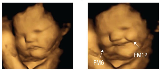 Les bébés sourient devant les carottes, grimacent devant le chou frisé dans le ventre, nouvelle étude sur le fœtus