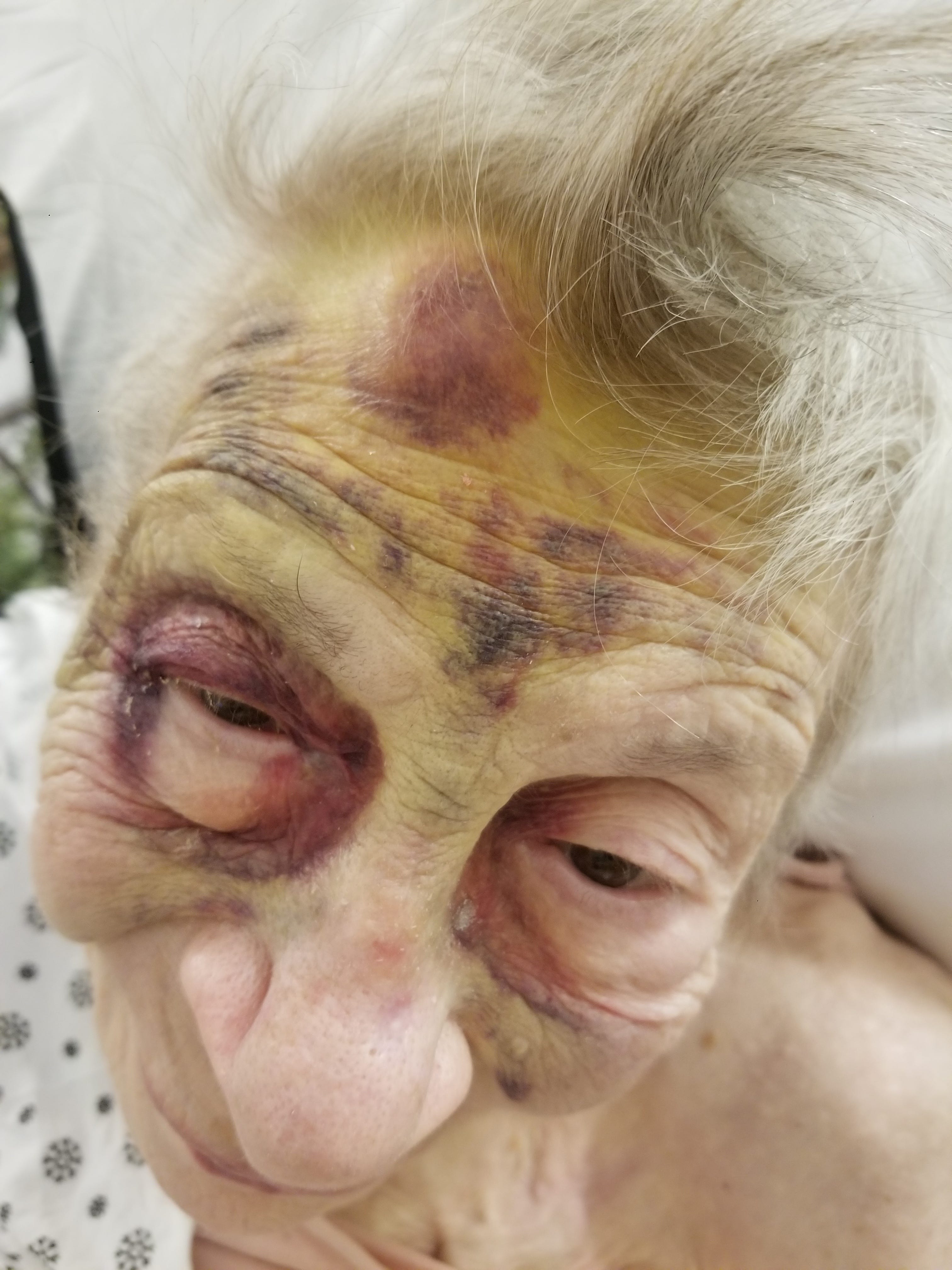 Grace Campbell lived in New York's Amsterdam Nursing Home until her death in January 2022 at the age of 98. Claire Campbell says her mother had multiple falls while a resident because of understaffing. Describing the photograph, she said: 