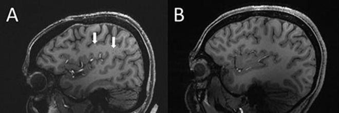(A) Enlarged centrum semiovale (CSO) perivascular spaces (PVS) (arrows) on sagittal T1-weighted MRI in a case with chronic migraine. (B) Migraine-free control without enlarged CSO PVS.