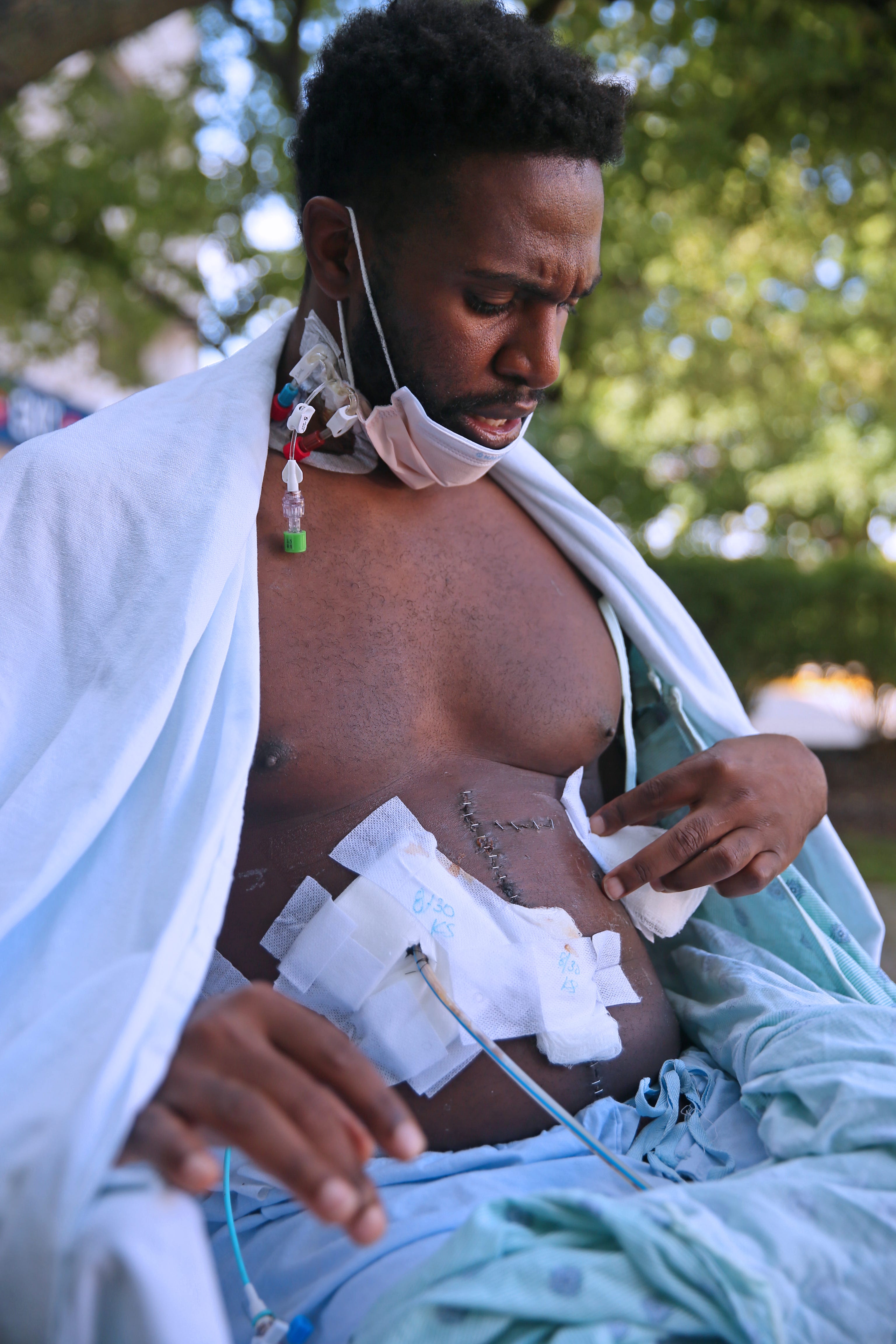 Marlin Dixon shows his wounds outside Froedtert Hospital on Friday, Sept. 2. Dixon was stabbed in the stomach and back during a dispute with his then-girlfriend on Aug. 18, at their apartment in Menomonee Falls.