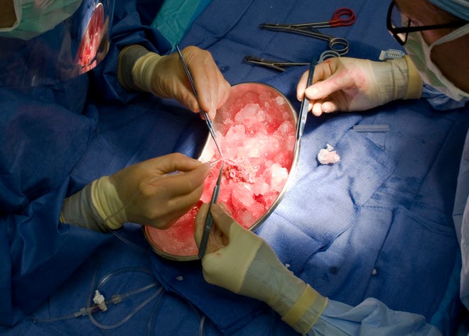 BESTAND - Op deze bestandsfoto van 4 oktober 2010 werken artsen aan een onlangs verwijderde nier van een donor in een ziekenhuis in Portland.  Torsten Kjellstrand/The Oregonian AP, Bestand)