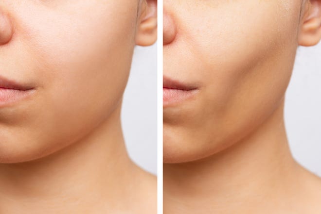 Before and after plastic surgery buccal fat removal.
