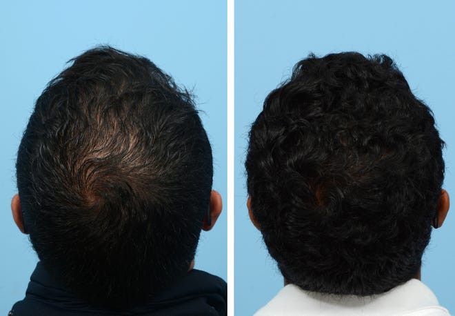 Dr. Wise was able to stimulate natural hair growth and increase the overall density on this 22-year-old patient with 3 sessions of Platelet Rich Plasma (PRP) therapy. Six months after his third treatment, the results are amazing, and he is very pleased with the renewed thickness of his hair.