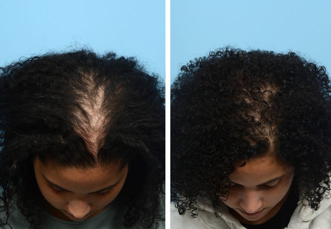 Postpartum hair loss is very common — so much so that approximately 90% of women will experience some form of it. Dr. Wise was able to reverse the hair loss for this patient with a series of three Platelet Rich Plasma Therapy sessions. Six months post-treatment, the patient is very happy and her results really speak for themselves.