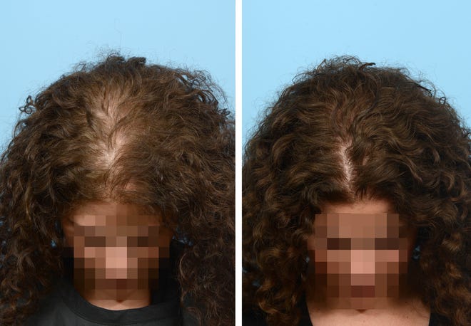 Stress-related hair loss brought this 48-year-old patient to the Wise Institute for Hair Restoration. Following Dr. Wise's recommendations, she had two sessions of combined Platelet Rich Plasma and Exosome therapies, spaced 1 year apart. Six months after her second treatment, she is amazed by how thick and luscious her hair looks, and how healthy her scalp has become post-treatment.