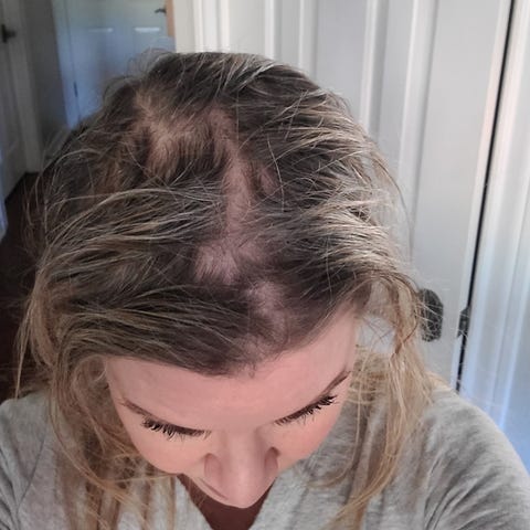 This woman believes bald spots were caused by usin