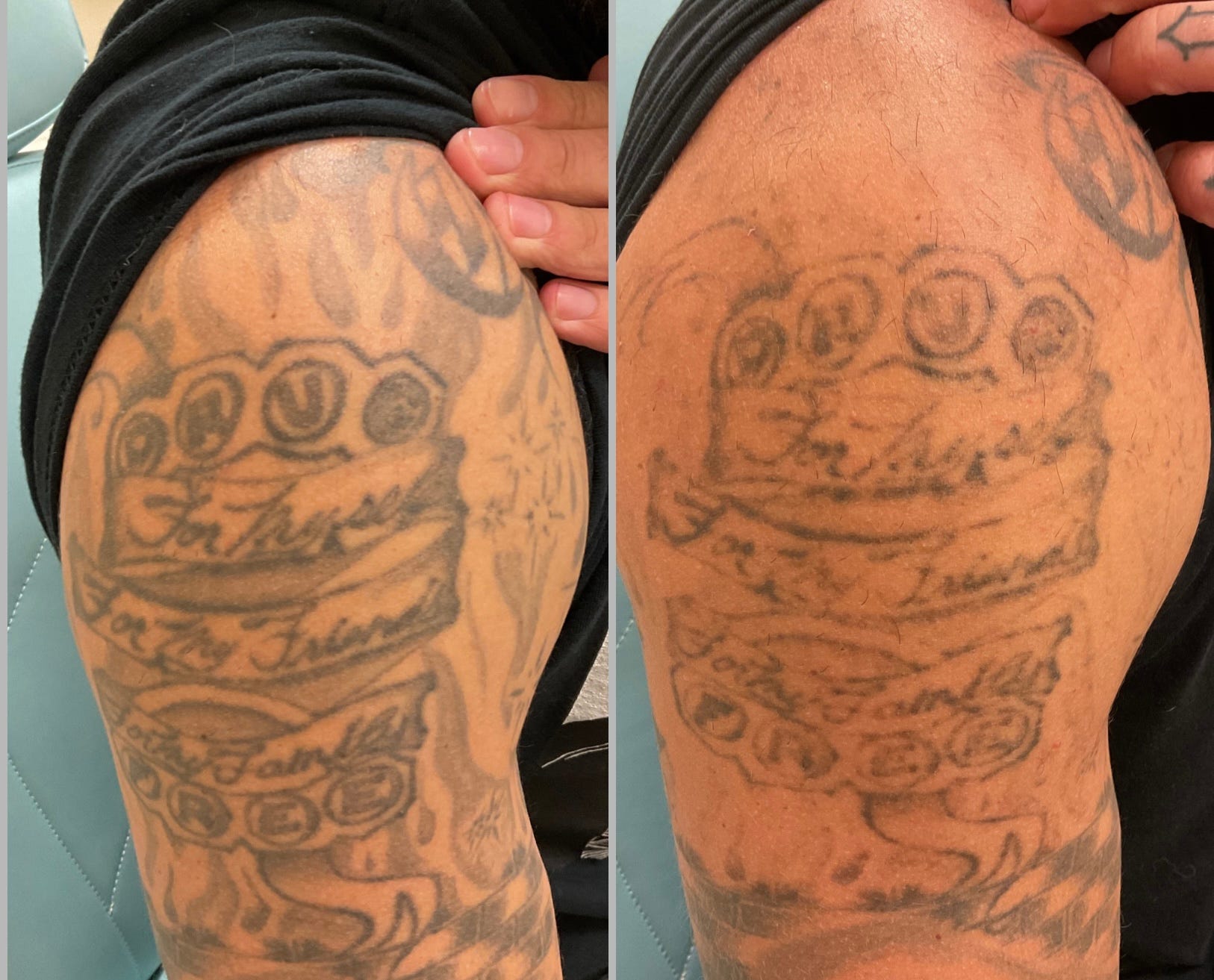 Tattoo regrets, removal, warnings from an Asheville skin specialist Tattoo regrets, removal, warnings from an Asheville skin specialist