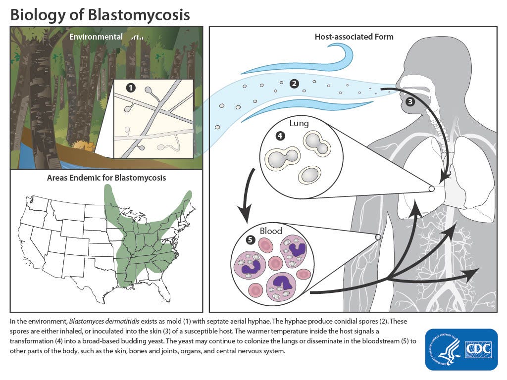 The fungal spore that can cause blastomycosis is found throughout the Great Lakes region and eastern U.S.